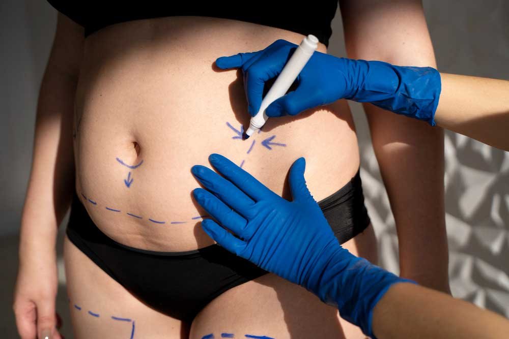 Abdominoplasty post measurements