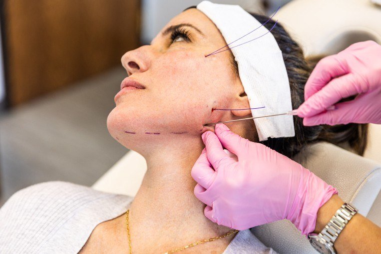 Thread Lift treatment in clinic